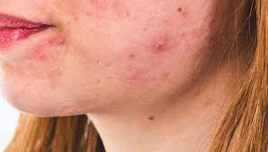 accutane side effects what are they