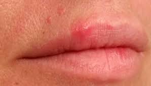 what do herpes lesions look like