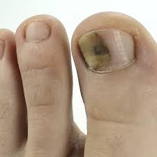 toenail fungus