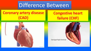 coronary artery disease cad
