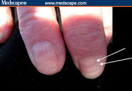 finger nails to predict health