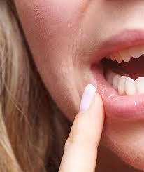 Mundfäule ist eine durch herpesviren verursachte entzündung im mund. Herpes Im Mund Erkennen Und Behandeln Lippenherpes Ratgeber