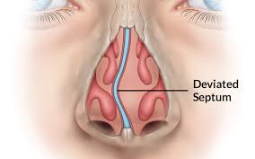 What are the treatment options? Deviated Septum St Louis Mo Deviated Septum Surgery Septoplasty