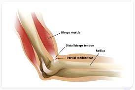 distal biceps tendon rupture symptoms