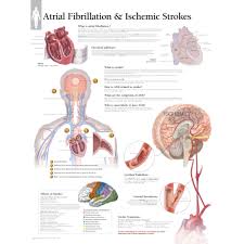 Atrial Fibrillation Ischemic Strokes Chart