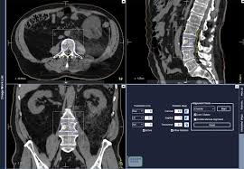 stereotactic radiotherapy