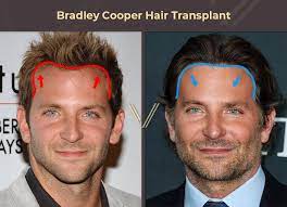 celebrities with hair transplants 40