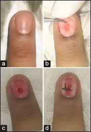 nail bed glomus tumour removed