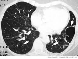 Medical marijuana can help relieve pulmonary fibrosis symptoms. Patrones Radiologicos En La Enfermedad Pulmonar Intersticial Seminarios De La Fundacion Espanola De Reumatologia