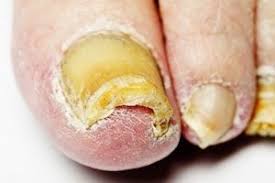 nail fungus foot healthcare ociates