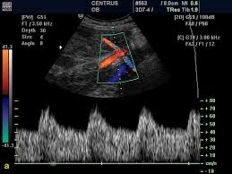 Doppler Ultrasound Principles And Practice
