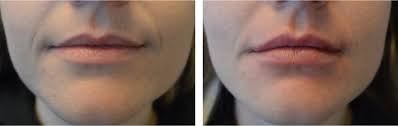 what is lip augmentation how do you