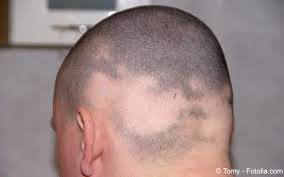 Alopecia is loss of hair that comes in a variety of patterns with a variety of causes, although often it is idiopathic. Alopezie Symptome Diagnostik Therapie Gelbe Liste