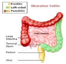 21 Best Pancolitis Images Ulcerative Colitis Ulcerative