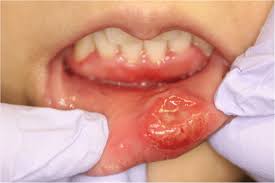 a photograph of the lower lip lesion of