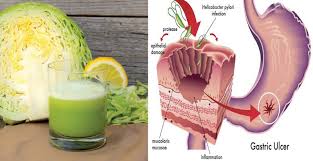 this cabbage juice heals stomach ulcers