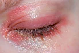 eczema around eyes causes symptoms