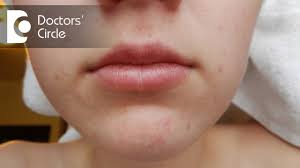 what causes acne around the mouth dr