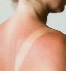 what not to do if you get sunburned