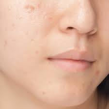 dark spots acne and freckles