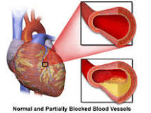 Cardiac arrest - Wikipedia