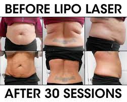 lipo laser weight loss liberation
