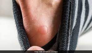 6 home remes to cure blisters