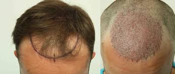 hair transplant after 14 days photos