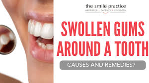swollen gums around a tooth causes and