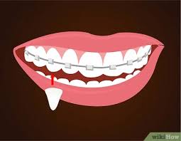 Home more advice beauty & style. How To Make Vampire Fangs If You Have Braces 12 Steps