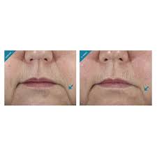 It claims to reduce fine lines and wrinkles while improving skin smoothness, plumpness, and laxity. Before After Skinceuticals H A Intensifier Http Facesofsouthtampa Com Skinceuticals Htm Tampa South Skinceuticals Skin Firming Skin Care