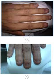 nail patella syndrome with infertility