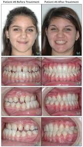 Underbite (class iii malocclusion/prognathism) is an orthodontic condition where lower teeth extend past upper teeth. Braces Before Afters Walton Orthodontics