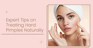hard pimples naturally