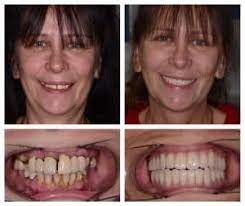full mouth dental implants costs