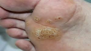 how to get rid of plantar warts in most