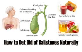 How To Get Rid Of Gallstones Naturally
