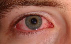 the many causes of a red eye