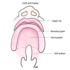 of cleft explained cleft lip palate