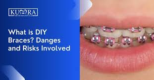 what are diy braces dangers and risks