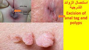 excision of anal tag and polyp استئصال الزوائد الشرجية - YouTube