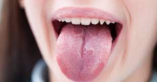why is your tongue white doctors talk
