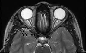 Optic Nerve Sheath Diameter on MR Imaging: Establishment of Norms and  Comparison of Pediatric Patients with Idiopathic Intracranial Hypertension  with Healthy Controls | American Journal of Neuroradiology