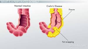 perforated bowel definition symptoms
