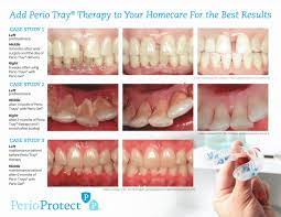 perio protect gum disease treatment