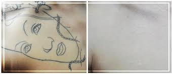 In some cases, the size of your tattoo may also impact the length of your total treatment. Picosecond Lasers Meeting Advanced Tattoo Removal And Changing Demographics Needs Modern Aesthetics