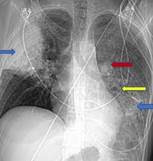 pulmonary adenocarcinoma mimicking