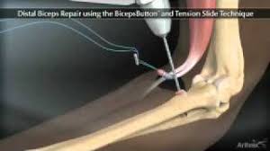 distal biceps repair animation you