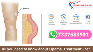 lipoma treatment cost in hyderabad