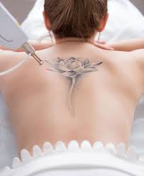 permanent tattoo removal in hyderabad